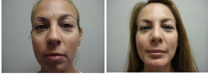 Rhino & Chin Implant