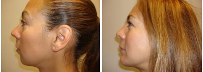 Rhino & Chin Implant