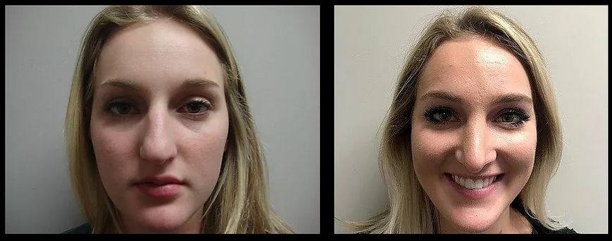 Rhinoplasty