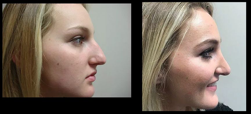 Rhinoplasty