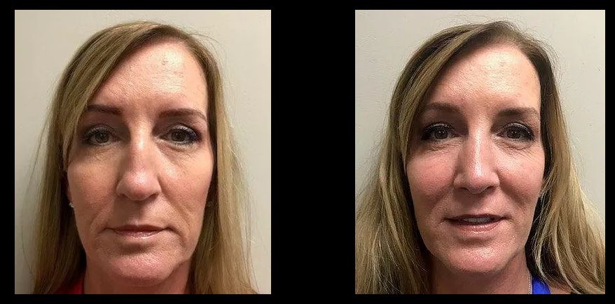 Rhinoplasty