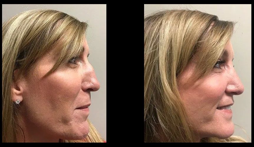 Rhinoplasty