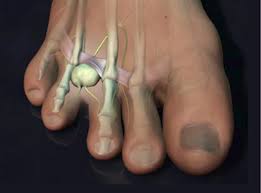 Neuroma