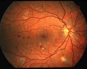 diabetic retinopathy