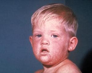 Measles Outbreak 2025