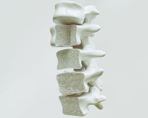 Preventing Osteoporosis