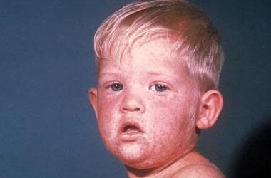 Measles Outbreak 2025