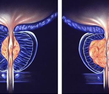 PAE For An Enlarged Prostate