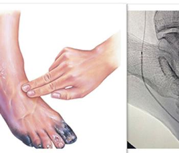 PAD Interventions
