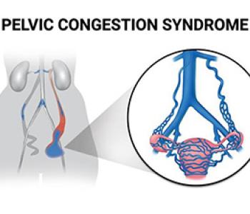 Embolization For Pelvic Congestion Syndrome