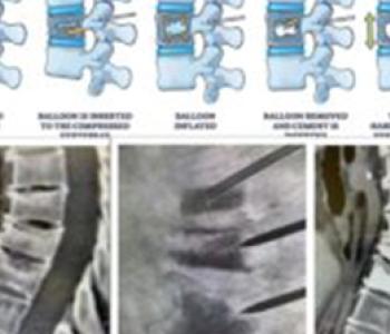  Spine Interventions