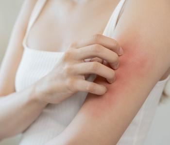 Skin Rashes