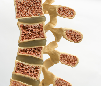 Osteoporosis